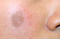 テープ保護～約2週間経過