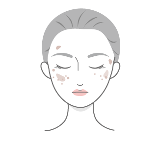 シミのイメージ