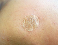 肌色テープ保護