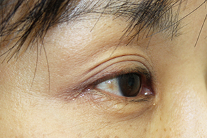 眼瞼内反症治療後