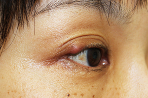 眼瞼内反症症例治療前